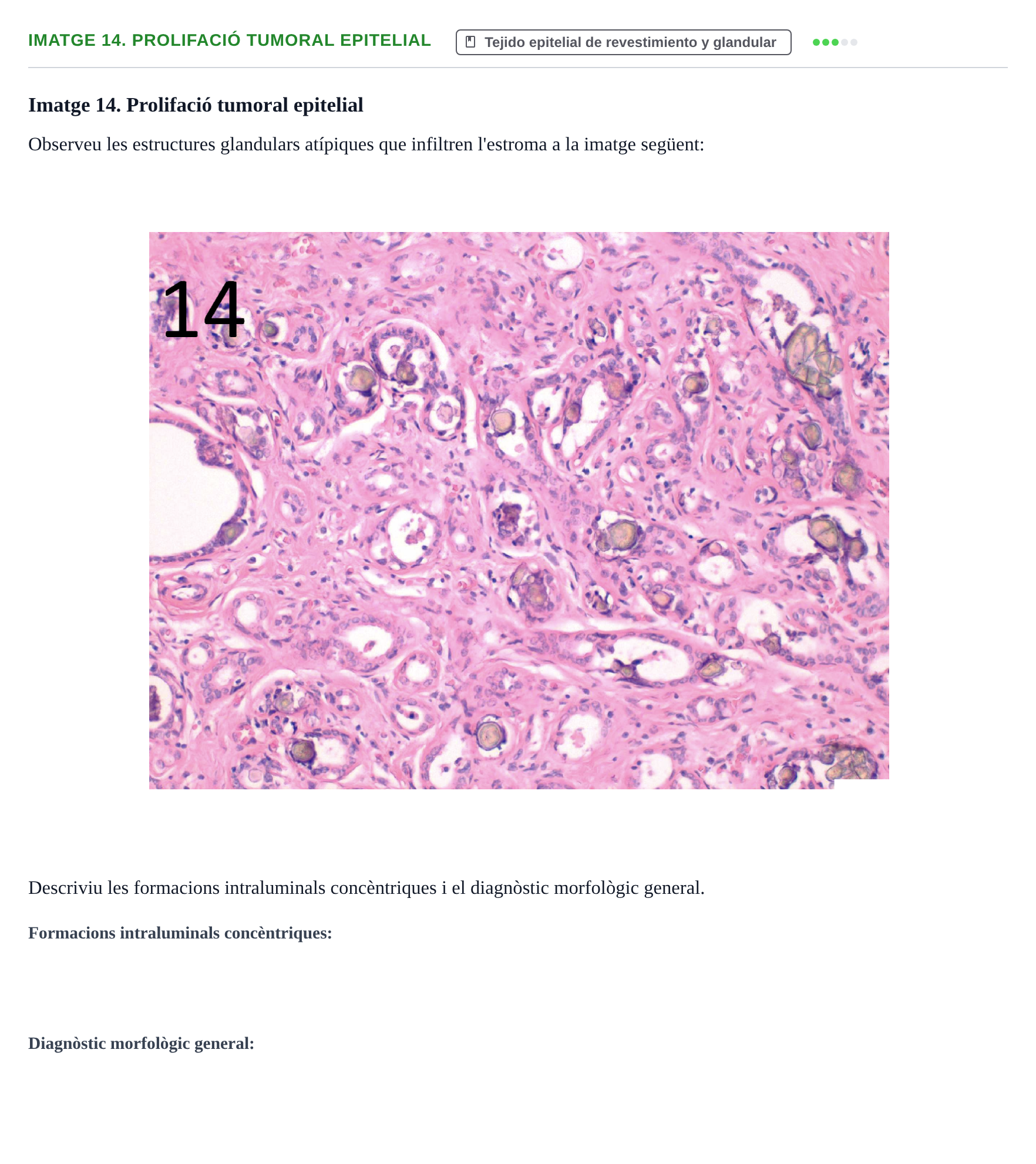 Enunciado: Ejercicio Imatge 14. Prolifació tumoral epitelial · Anatomia Microscòpica UDL 2015