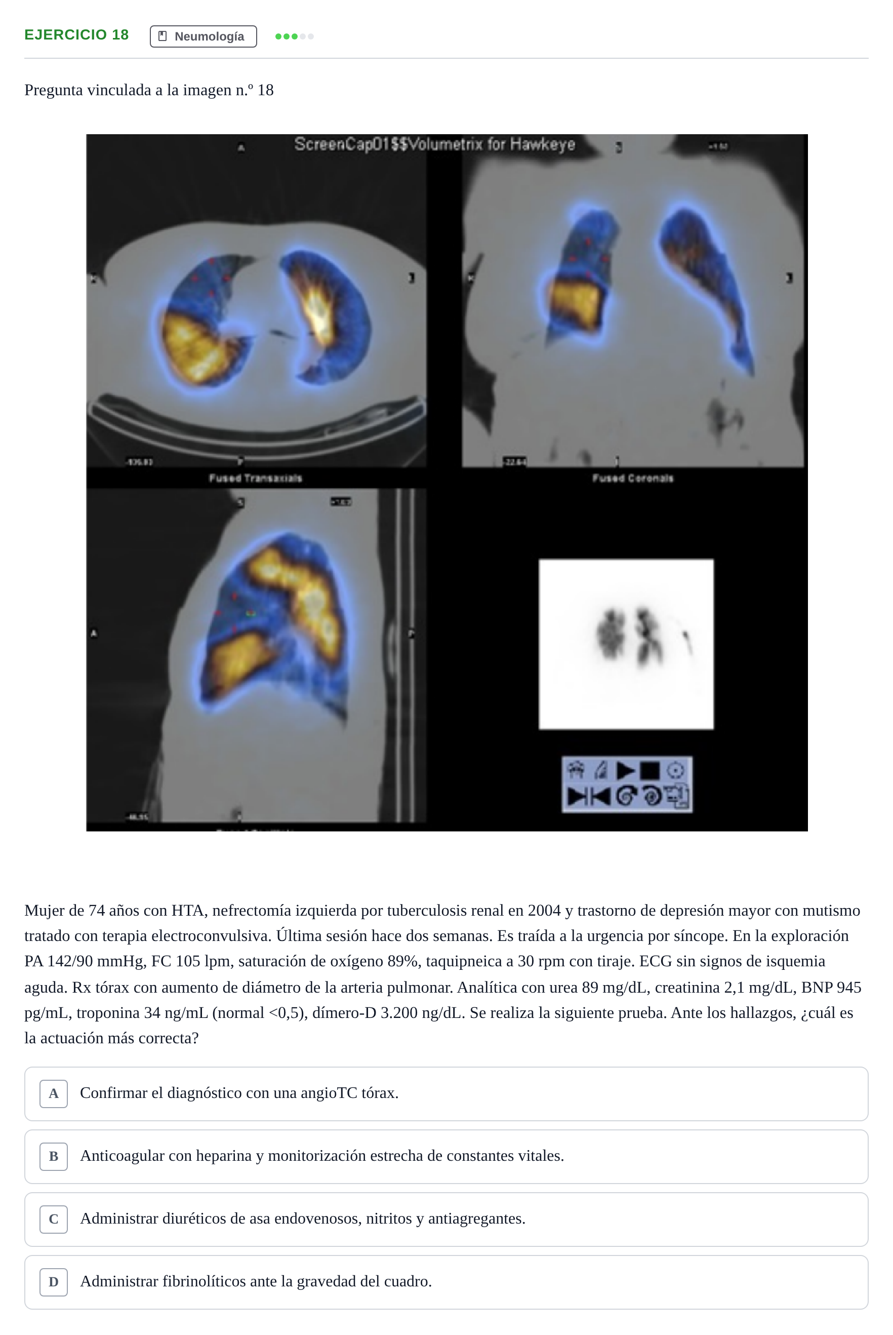Enunciado: Pregunta 18 · MIR 2018 — Tromboembolismo pulmonar en gammagrafía de ventilación/perfusión