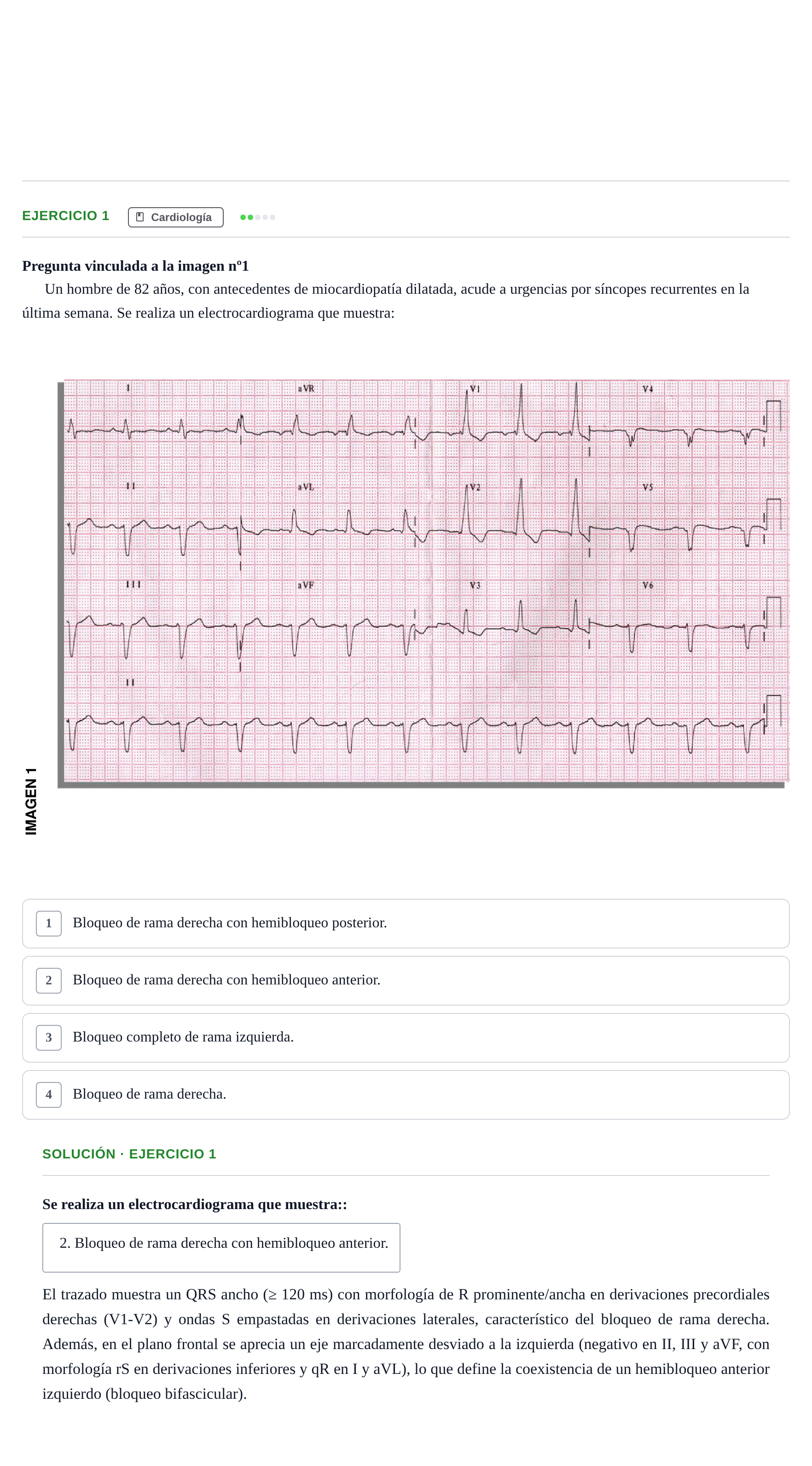 Enunciado: Pregunta 29 · MIR 2018 — Hipertensión intracraneal idiopática con papiledema: hallazgos