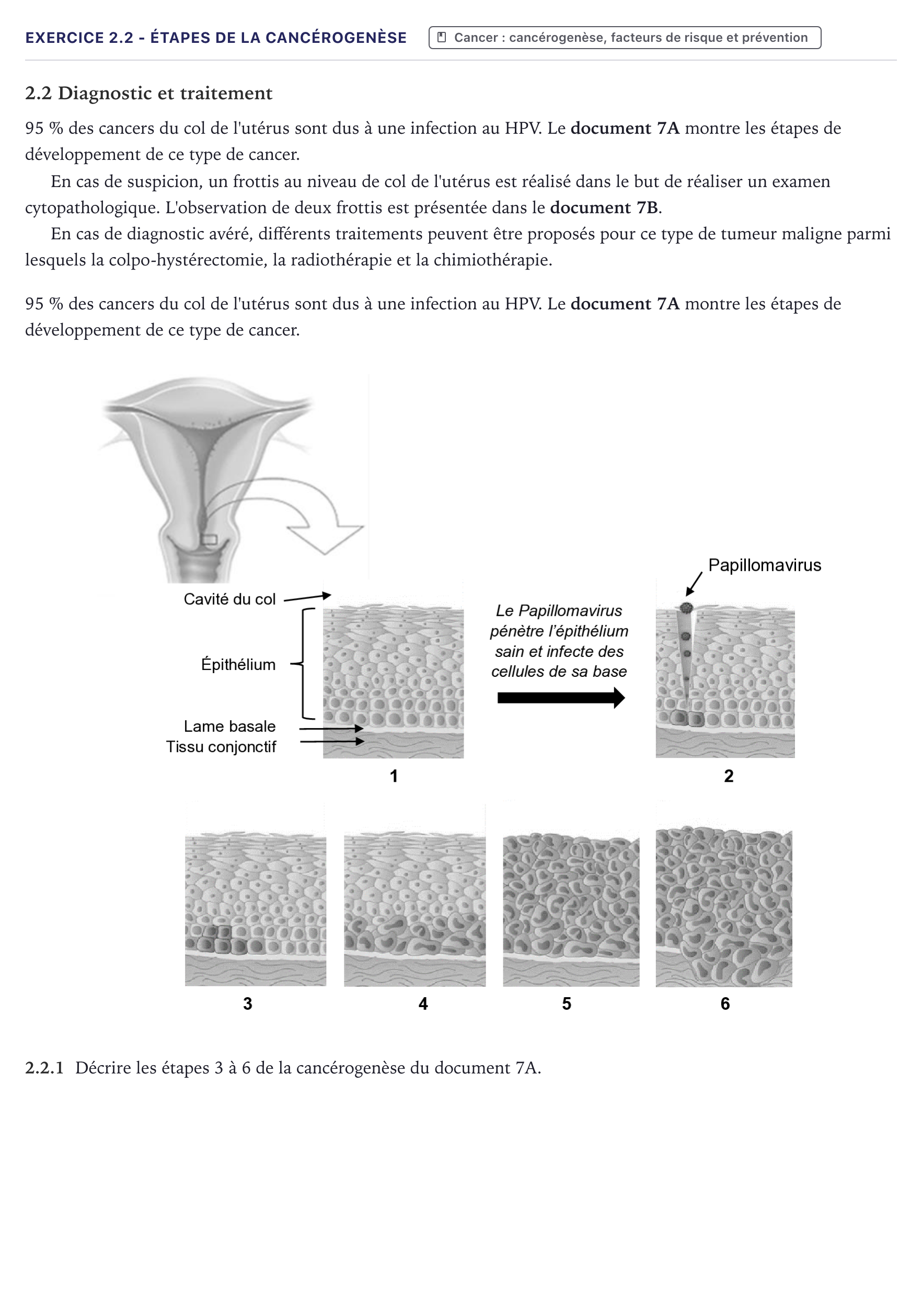 Énoncé: Exercice 2.2 - Étapes de la cancérogenèse · Bac ST2S Chimie, Biologie et Physiopathologie Humaines Métropole 2025